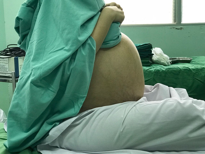 Cô gái 20 tuổi với chiếc bụng mang khối u khổng lồ trước khi được phẫu thuật. (Nguồn: TTXVN phát) Phẫu thuật khối u buồng trứng nặng 18kg cho một cô gái ảnh 2