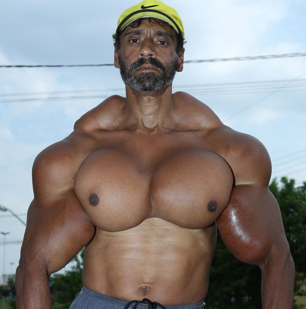 Chỉ vì muốn "đẹp nhân tạo," người đàn ông bơm chất độc vào cơ thể ảnh 2