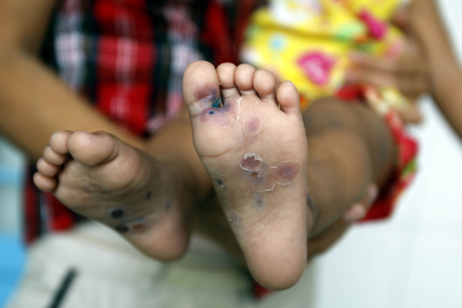 Bệnh tay chân miệng diễn biến phức tạp tại Bà Rịa-Vũng Tàu ảnh 1