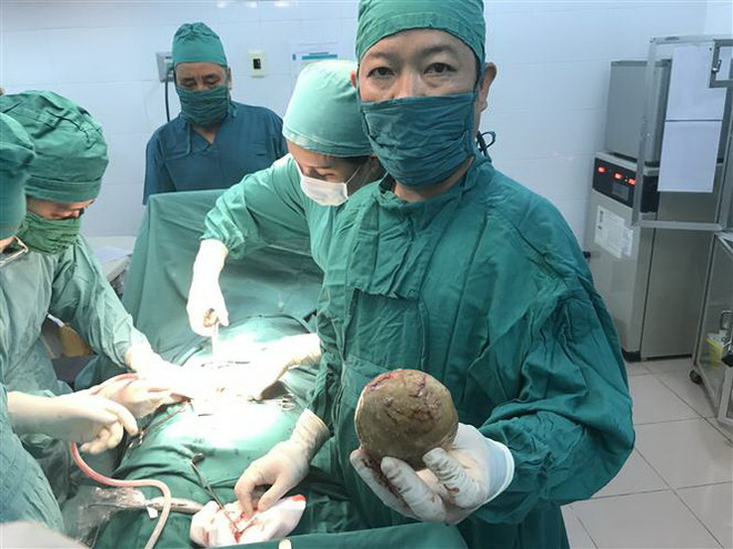 Lấy thành công viên sỏi gần nửa kg khỏi bàng quang bệnh nhân ảnh 1