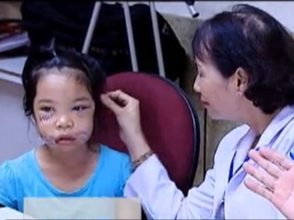 [Video] Bình Phước: Bé gái phải khâu hơn 200 mũi do bị chó cắn ảnh 1