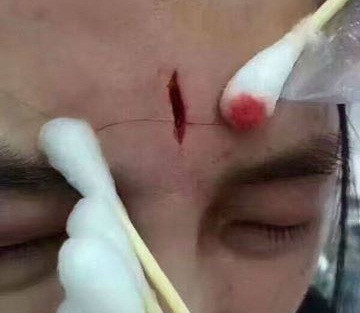 Y tá viện nhi bị đánh rách trán vì tiêm lệch ven bệnh nhân 3 tuổi ảnh 1