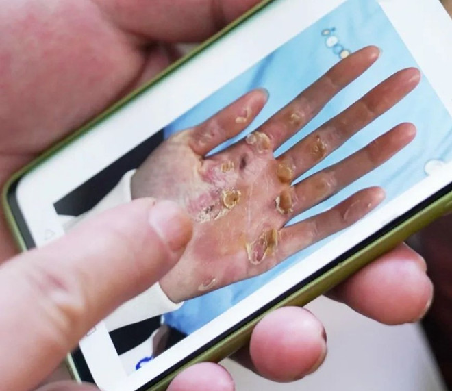 ASIAD 2023: Xót xa hình ảnh bàn tay biến dạng của nhà vô địch Rowing ảnh 1