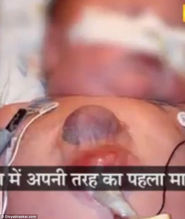 Xót thương chàng trai nghèo có trái tim nằm ngoài cơ thể ảnh 3