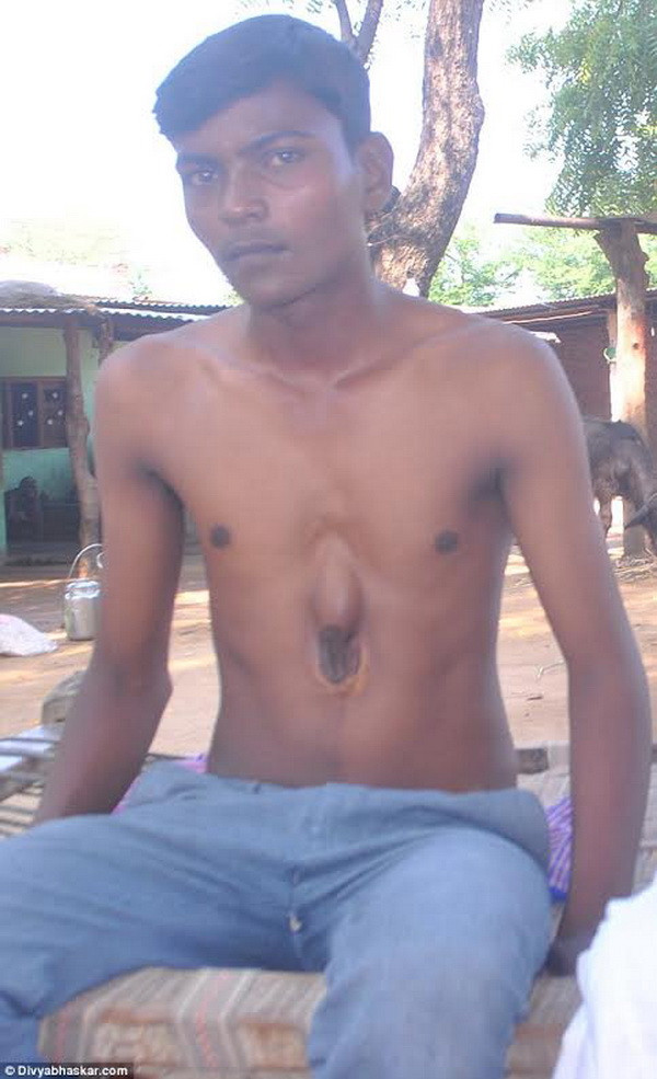 Xót thương chàng trai nghèo có trái tim nằm ngoài cơ thể ảnh 2