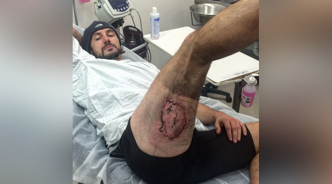 Bị bỏng mất cả mảng da đùi vì iPhone 6 phát nổ trong túi quần ảnh 1