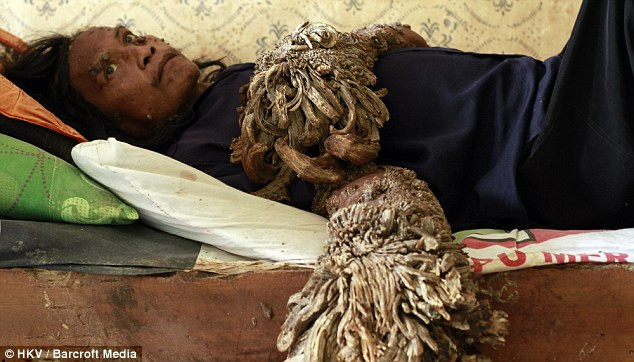 “Người cây” Indonesia qua đời khi chưa được làm thợ mộc ảnh 3