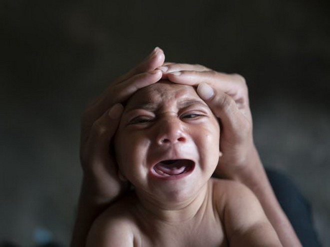 Mỹ xác định thai nhi đầu tiên bị dị tật đầu nhỏ liên quan tới Zika ảnh 1