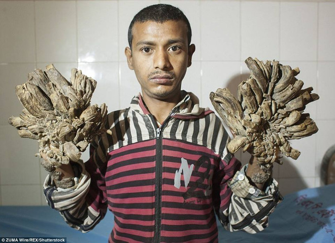 [Photo] Xót xa chứng kiến căn bệnh "người cây" quái ác hiếm gặp ảnh 1