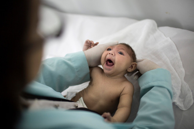 Một trẻ sơ sinh bị chứng đầu nhỏ do nhiễm virus Zika. (Nguồn: AP) Trẻ sơ sinh đầu tiên ở châu Âu mắc chứng đầu nhỏ do nhiễm Zika ảnh 1