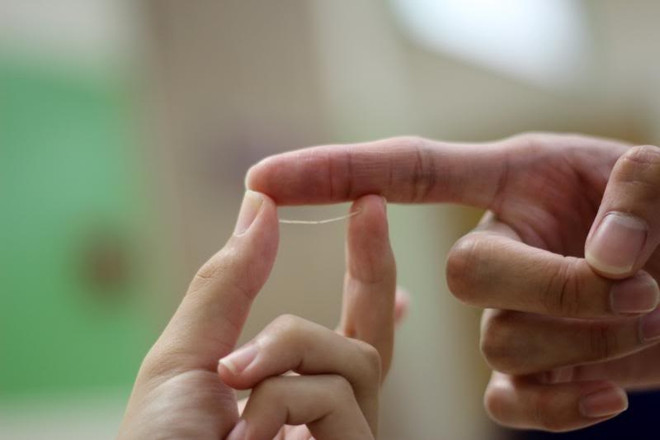 Gắp thành công chiếc xương cá nằm trong cổ bệnh nhân suốt 3 tháng ảnh 1