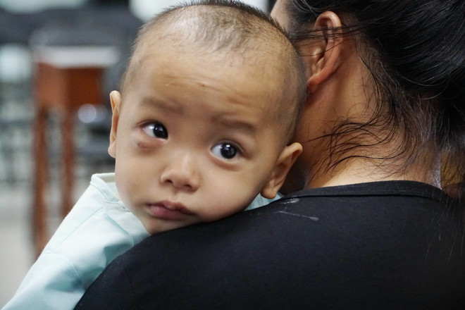 Cấp cứu kịp thời bé trai viêm xoang gây biến chứng áp xe mắt khổng lồ ảnh 1