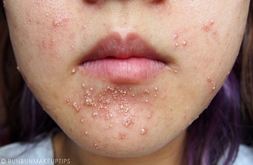 Những biện pháp giúp xử lý làn da bị kích ứng nghiêm trọng ảnh 1