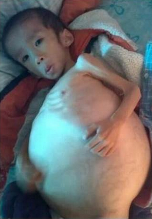 Bé trai 5 tuổi mắc chứng bệnh lạ bụng phình to như quả dưa hấu ảnh 1