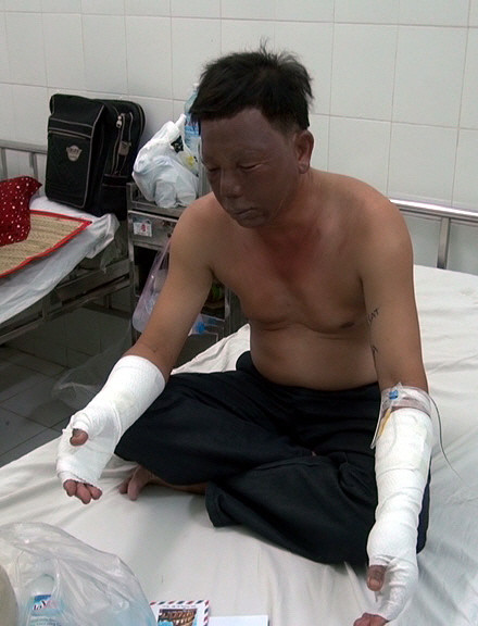 [Photo] 10 giáo viên và học sinh bỏng nặng do nổ bóng bay ảnh 1