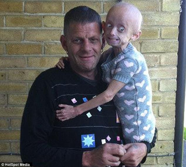 Bé gái mắc bệnh hiểm nghèo không được đội tóc giả ở trường ảnh 2