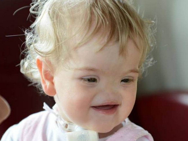 Cô bé 17 tháng tuổi không có mũi nhưng vẫn luôn nở nụ cười ảnh 1