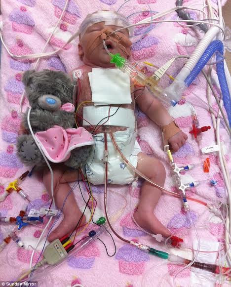 Em bé trải qua phẫu thuật tim mở vài phút sau khi sinh ảnh 1