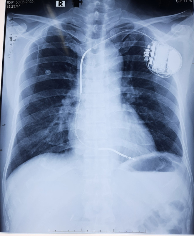 Cấy máy phá rung tự động, cứu sống bệnh nhân bị ngưng tim, ngưng thở ảnh 2