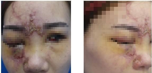 Cô gái suýt mù mắt do tiêm filler làm đẹp tại cơ sở thẩm mỹ ảnh 1