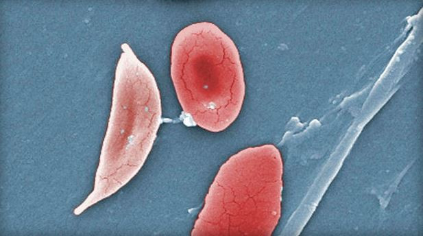 Đột phá mới trong việc điều trị bệnh hồng cầu hình liềm ảnh 1