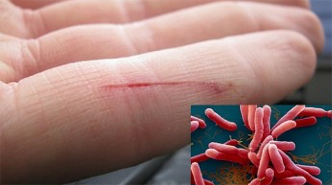 Thanh Hóa: Ghi nhận trường hợp mắc "khuẩn ăn thịt người" chưa rõ nguồn ảnh 1