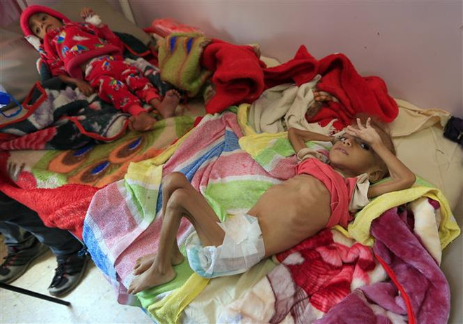 Hơn 85.000 trẻ em chết vì đói và bệnh tật tại Yemen trong 3 năm qua ảnh 1