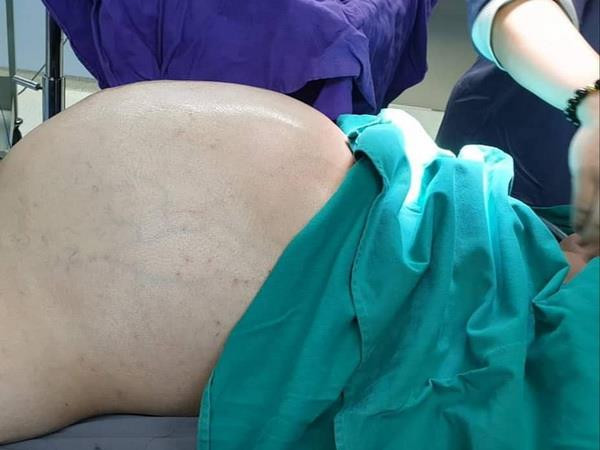 Cắt bỏ khối u 'khổng lồ' nặng 25kg trong bụng nam thanh niên ảnh 1