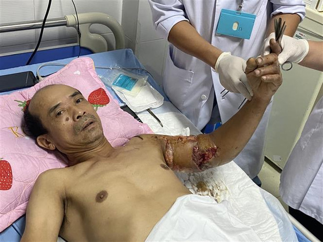 Sau 10 ngày phẫu thuật, hiện tại cánh tay nối được tưới máu tốt, hồng hào trở lại, vết nối khô. (Ảnh: TTXVN phát) Thanh Hóa: Nối thành công cánh tay bị đứt lìa cho nam bệnh nhân ảnh 1