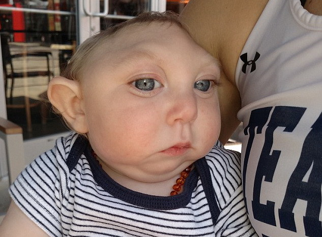 Cậu bé mất não bẩm sinh sống sót thần kỳ đón sinh nhật đầu tiên ảnh 1