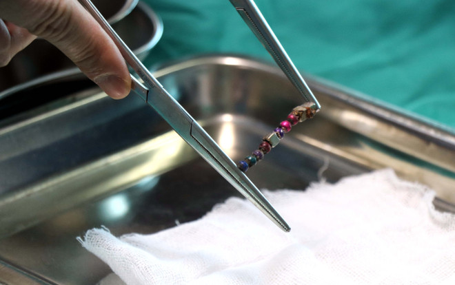 Phẫu thuật kịp thời lấy ra 10 viên nam châm trong ruột bệnh nhi ảnh 1