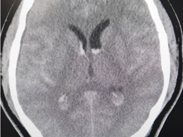 Cứu sống một bệnh nhân Hàn Quốc chảy máu dưới nhện nguy kịch ảnh 1