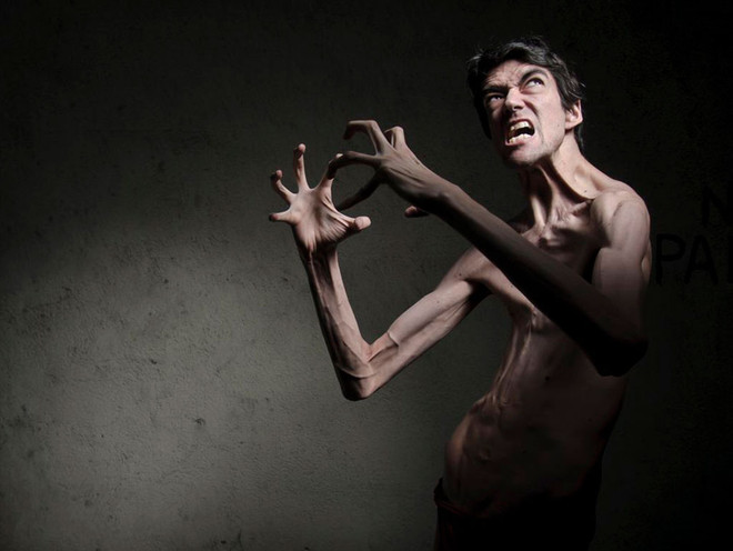 Nam diễn viên người Tây Ban Nha Javier Botet mắc hội chứng Marfan khiến tứ chi dài bất thường và có khả năng uốn dẻo cơ thể đến mức kỳ lạ. (Ảnh: Twitter) javier-botet4_MFQK.jpg