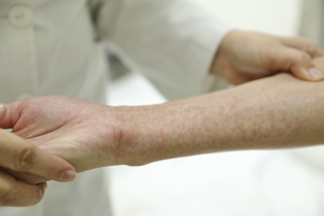 Tình hình dịch bệnh sốt xuất huyết tại Long An diễn biến phức tạp ảnh 1