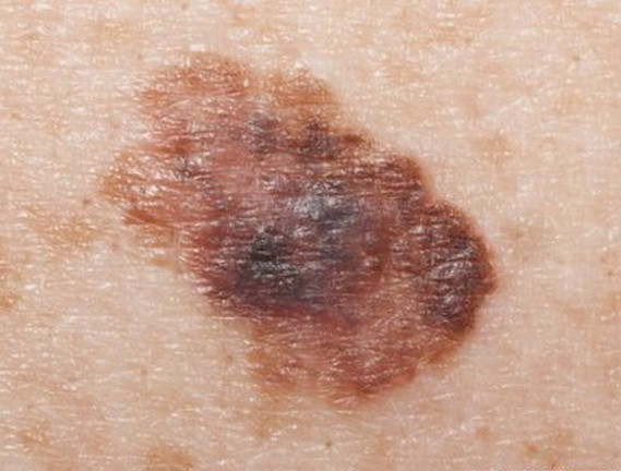 Cảnh báo chất chống ôxy hóa đẩy nhanh quá trình di căn ung thư ảnh 1