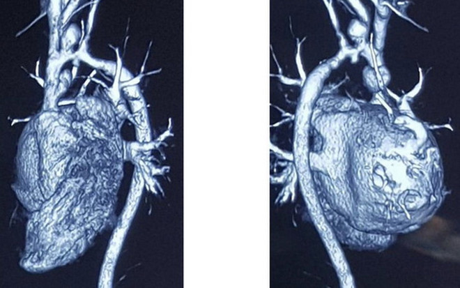 Bé trai 8 tuổi tìm được sự sống từ động mạch của người cho chết não ảnh 1