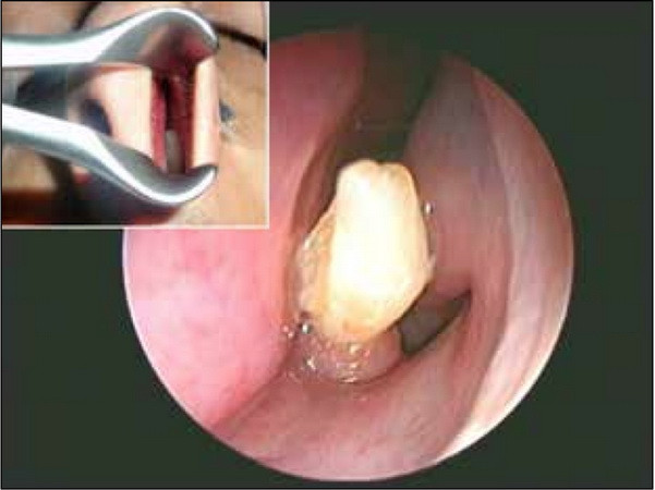 Kinh hoàng khi phát hiện ra một chiếc răng dài mọc trong mũi ảnh 1