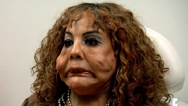 Người phụ nữ bị biến dạng khủng khiếp do tiêm keo vá xe vào mặt ảnh 1