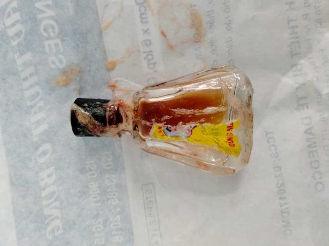 An Giang: Cấp cứu thành công lấy dị vật trong họng bé gái 5 tuổi ảnh 1