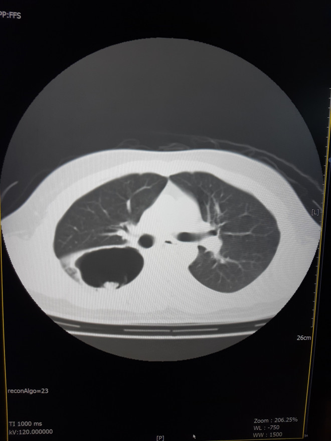 Bệnh viện C Đà Nẵng phẫu thuật thành công ca bệnh u nấm phổi phức tạp ảnh 2