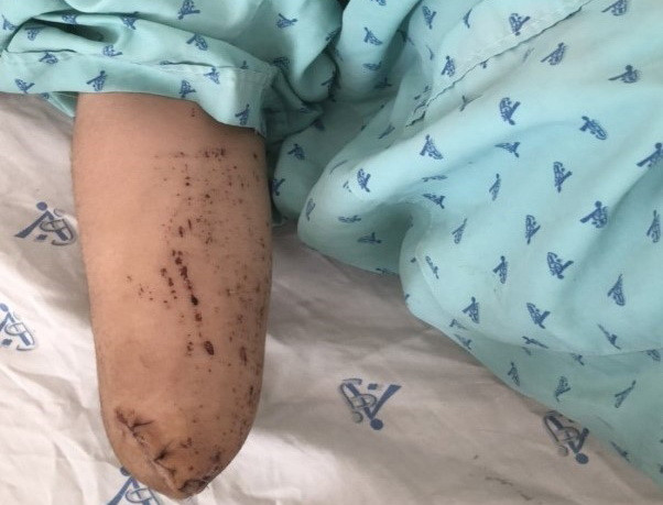 An Giang: Thanh niên 19 tuổi bị đứt lìa bàn tay do tự chế pháo ảnh 1