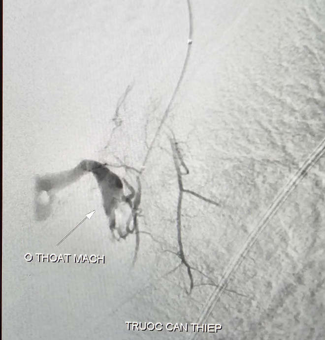 Cứu sống bệnh nhân sốc mất máu nguy kịch do vết thương thấu ngực ảnh 2