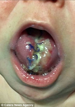 Mắc hội chứng lạ, bé sơ sinh có lưỡi to như lưỡi người lớn ảnh 4