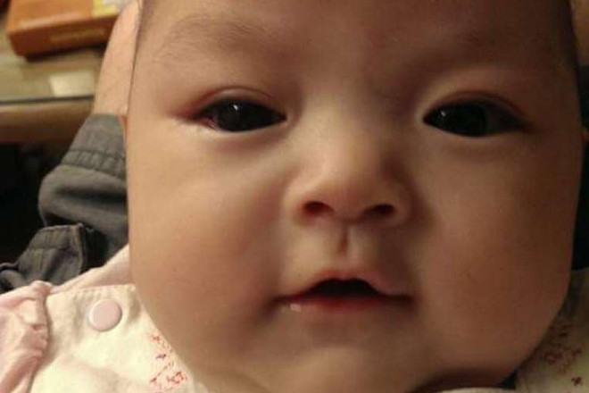 Xót xa em bé 4 tháng tuổi bị cắt bỏ đôi mắt vì bị ung thư ảnh 2
