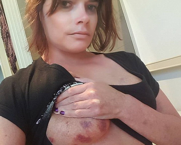 Nạn nhân bị hiếp dâm dũng cảm chia sẻ ảnh thương tích khủng khiếp ảnh 1