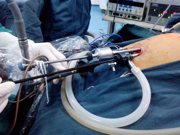 Bệnh viện tuyến tỉnh đầu tiên phẫu thuật nội soi một lỗ thoát vị bẹn ảnh 1