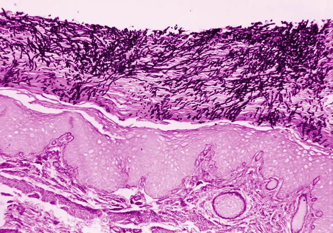 WHO lần đầu xác định bệnh nấm là mối đe dọa với sức khỏe con người ảnh 1