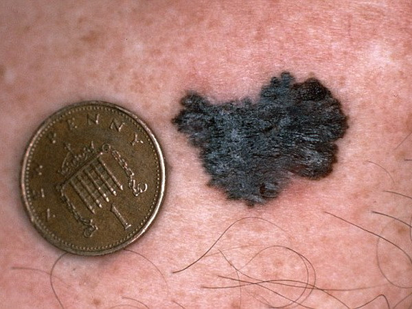 Nhiều đồng trong máu sẽ thúc đẩy tế bào ung thư phát triển ảnh 1