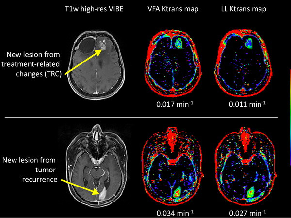 Tìm ra phương pháp mới chữa u não mà không cần phẫu thuật ảnh 1