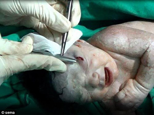 Cứu sống thành công em bé sơ sinh bị mắc mảnh đạn vào đầu ảnh 1